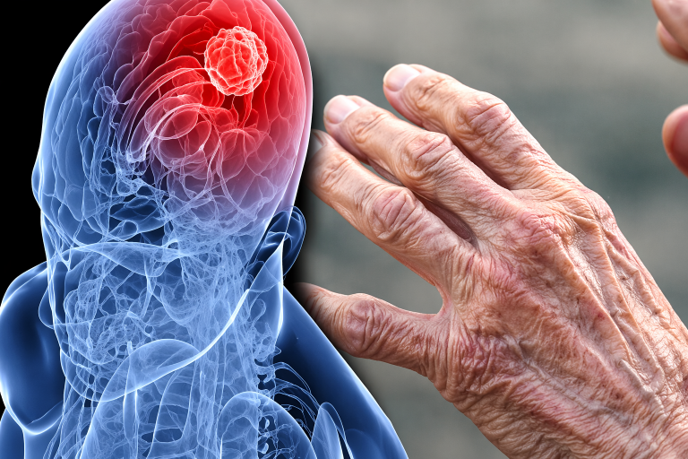 Parkinson’s Disease (1)