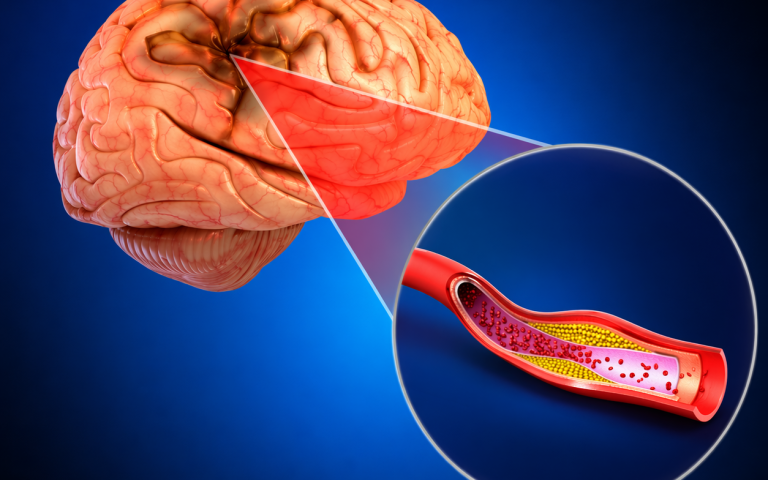 Stroke & Paralysis (4)