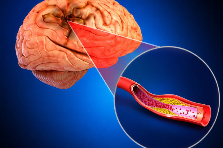 Stroke & Paralysis (4)
